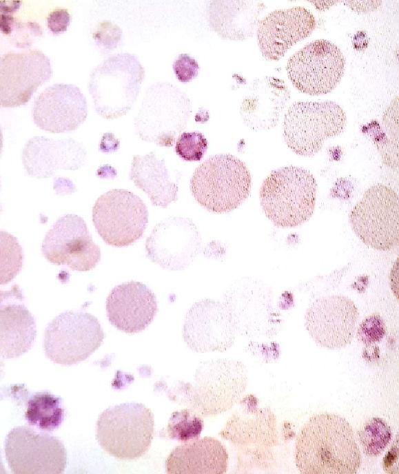 Figura 1: distendido sanguíneo de paciente com Trombocitemia Essencial plaquetose com variabilidade morfológica de plaquetas.