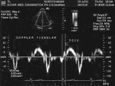 Tabela II - Índices de função diastólica pela ecodopplercardiografia convencional em 60 pacientes chagásicos com ou sem alterações eletrocardiográficas e 17 indivíduos normais Pacientes chagásicos