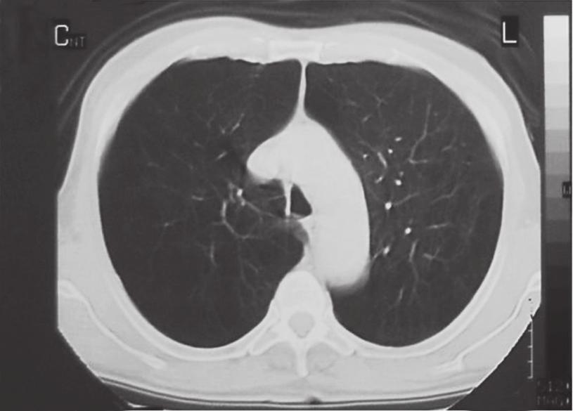 Aplicação terapêutica da ventilação colateral com drenagem pulmonar no tratamento do enfisema pulmonar difuso: relato dos três primeiros casos 15 ventilação normal, o ar inspirado e expirado percorre