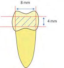 amelocementária e no sentido vestíbulo-lingual (Figura 7A), com o intuito de remover a superfície radicular e obter duas hemi-secções: uma mesial e uma distal, que foram utilizadas para análise da