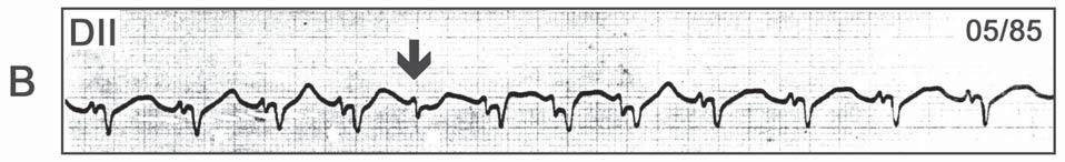 Em todos os pacientes havia uma importante disfunção ventricular e o padrão bizarro do QRS representando grave envolvimento do SIV.
