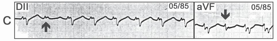 4 anos de evolução. O primeiro ECG (Figura 1A) apresentava um padrão de BRE.