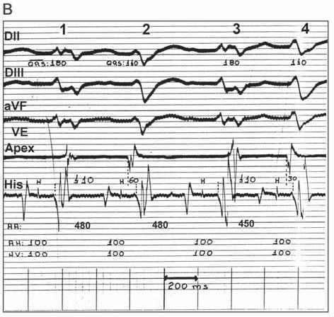 entretanto, não há perturbação na despolarização do VD e a seqüência normal da condução é mantida inalterada (como pode ser percebido pelos intervalos AH e HV que são constantes: 115ms e 100ms,