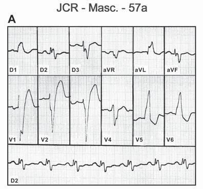 Figura 5A ECG evidenciando os complexos bipartidos nas derivações inferiores. Figura 5B Registros ampliados e em velocidade de 50mm/s de D2, D3 e avf.