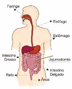 3 Gastrostomia