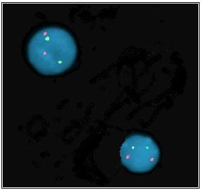 48 4.2 Citogenéica Molecular: Aplicação do FISH em SMD Primária na Infância (B A metodologia da citogenética molecular (FISH) foi utlizada em sete pacientes com SMD primária na infância.