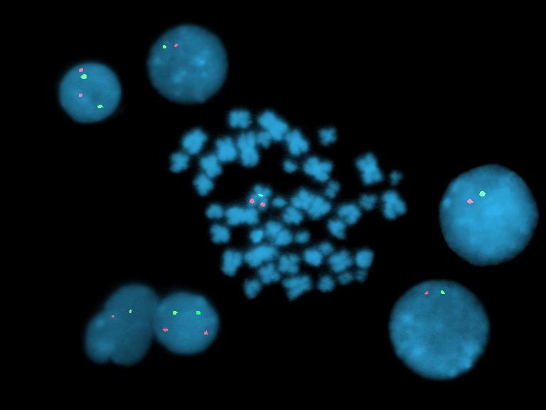 52 (B) (A) Fig. 12: Análise por citogenética clássica e citogenética molecular (FISH). (A) Cariótipo parcial, bandeamento G, mostrando a alteração cromossômica: -7.