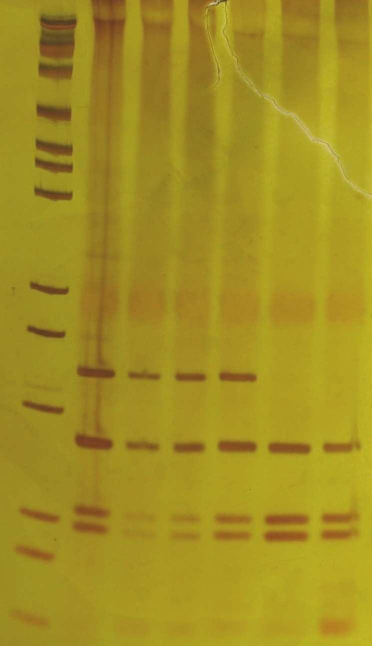 PM: Padrão de peso molecular Gel 1 canaletas 1 e 3: genótipo AB canaleta 2: genótipo AA Gel 2 canaletas1, 2, 3, e 4: genótipo AB canaletas 5 e 6: genótipo BB As freqüências gênicas e genotípicas
