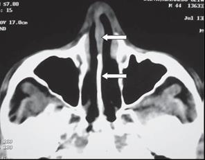 37 FIGURA 4: (A) VISÃO INTERNA DO NARIZ; (B) IMAGEM DE RESSONÂNCIA MAGNÉTICA DA ESTRUTURA INTERNA DO NARIZ Fonte: Souza et al, (2006, p. 368).