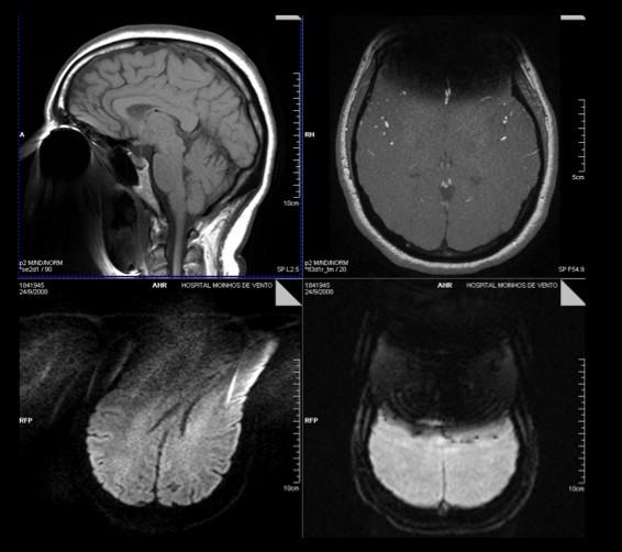 (a) (b) (c) (d) Figura 14. Artefato produzido por aparelho dentário em diferentes sequências de pulso usadas em exames de rotina do encéfalo.