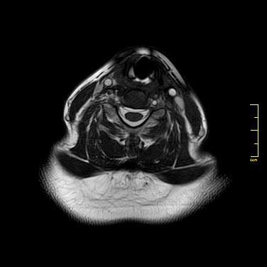 ); Plano Sagital T1 como ele é programado (Figura 14); E por fim Plano Axial T2 como ele é programado (Figura 15.). 9 (a) (b) (c) Figura 18.