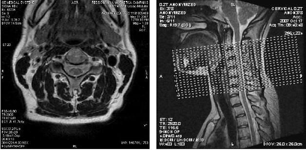 (a) (b) Figura 21. Plano Axial T2 como ele é programado. a) O FOV é marcado colocado no plano Axial; (b) Cortes marcados no localizador no plano Sagital. Fonte: Guia de Protocolos GE.