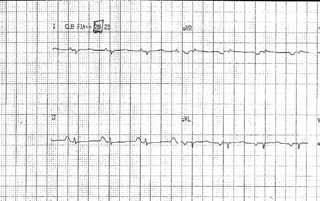 vacuolada. Fibrose intersticial e perivascular no miocárdio é evidente, sendo também mais proeminente na zona subendocárdica.