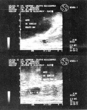 Diagnóstico ultra-sonográfico do momento ovulatório em búfalas (Bubalus bubalis) inseminadas no estro.
