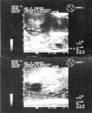 Figura 3 Imagens ecográficas do folículo ovulatório medido no seu maior diâmetro (cm) do início do estro até a ovulação, numa búfala testemunha (búfala nº 12, ovário esquerdo).