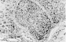 Análise da imunoexpressão do PCNA e p53 em carcinoma de células escamosas oral.