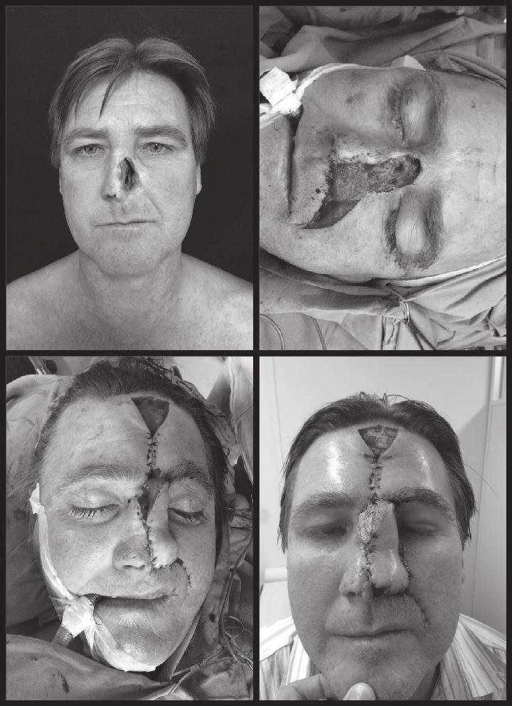 Principalization of plastic surgery. Boston: Little Brown; 1986. 4. Menick FJ. Nasal reconstruction. Plast Reconstr Surg.
