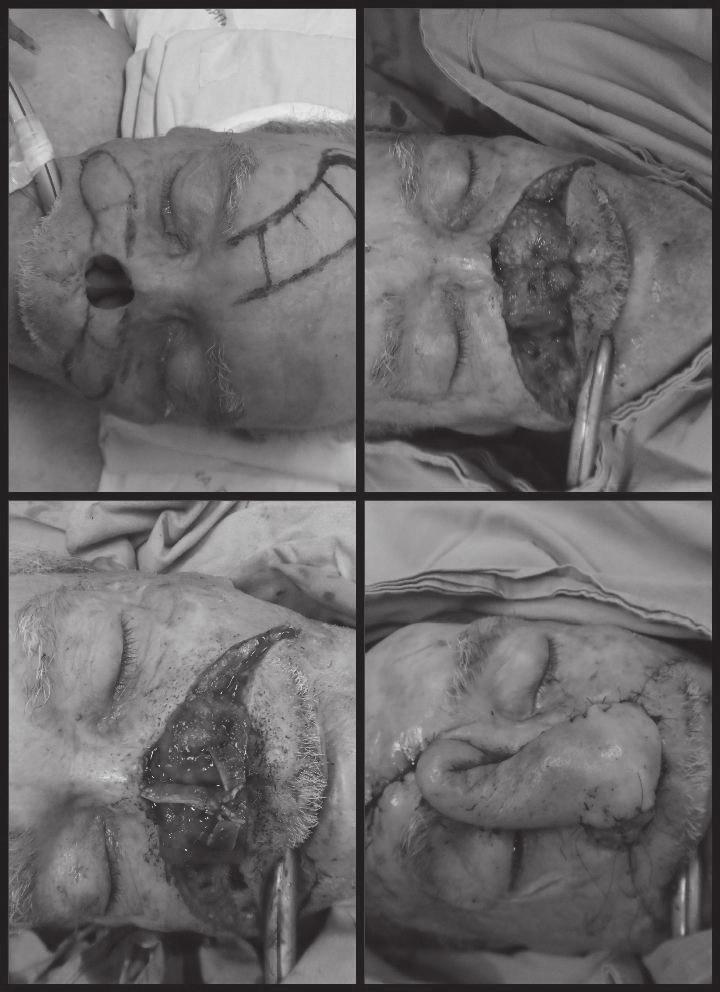The paramedian forehead flap: a dynamic anatomical vascular study verifying safety and clinical implications.