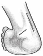 TRATAMENTO CIRÚRGICO DO PÉ TORTO CONGÊNITO GRAVE, NEGLIGENCIADO E NUNCA TRATADO NO PACIENTE ADULTO Fig. 1 Via de acesso para o tendão calcaneano Fig. 2 Alongamento do tendão calcaneano sem sutura Fig.