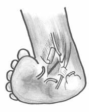 Fig. 4 Tenotomia do tibial posterior e flexor comum dos dedos Fig. 5 Secção dos planos superficiais e profundos do ligamento deltóideo Fig. 6 E.F.O., 20 anos aparelho gessado após artrodese tríplice.