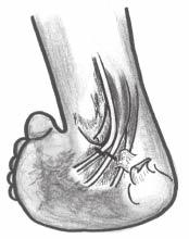 Após a terceira ou quarta troca de gesso, o paciente é submetido ao segundo tempo cirúrgico: artrodese tríplice clássica (em cunha) para correção do eqüino, varo e aduto (2,5,12).