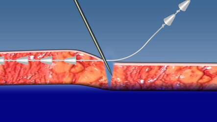 Os pontos de saída medial: Ponto A": 1 ou 2 cm lateral ao canto da boca (dependendo do tamanho do rosto). Ponto C': Apenas lateral à inserção Ala Nasi. Ponto B: 0,5 cm na vertical sobre o ponto C'.