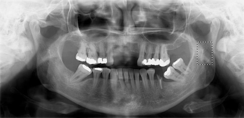 57 300px de ambos os lados (direito/esquerdo) focando a região do ramo da mandíbula (Figura 4.3). Essa região foi escolhida por ser uma área ampla sem sobreposição de estruturas anatomicas.