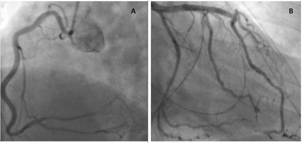 Figura 1 - Imagens da angiografia coronária do paciente que foi realizada 10 dias antes da admissão, mostrando artérias coronárias direitas (A) e esquerdas (B).