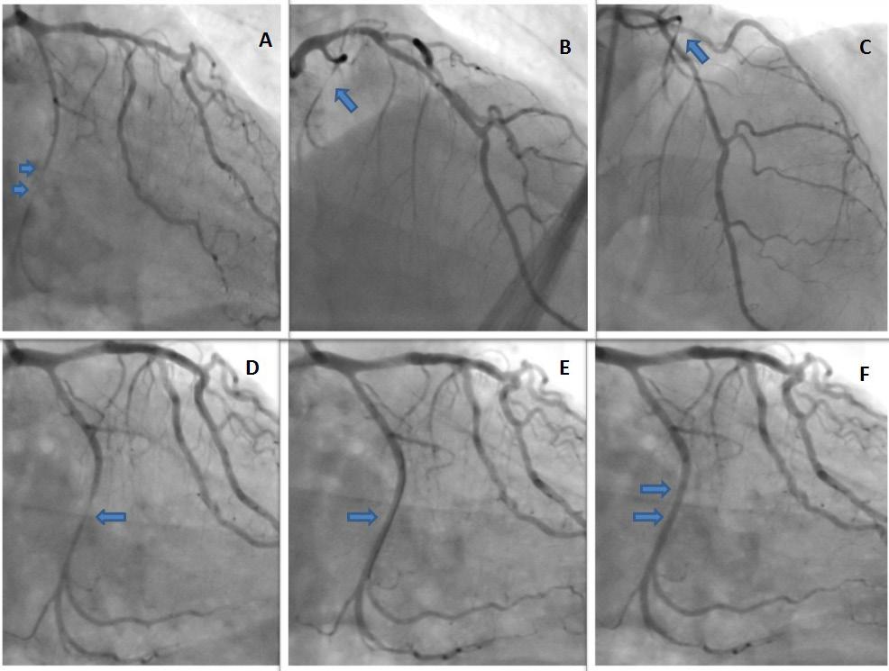 Fluxo distal aumentado apesar de resolução incompleta de espasmo da artéria circunflexa após injeção de 300 mcg de nitroglicerina (D), setas.