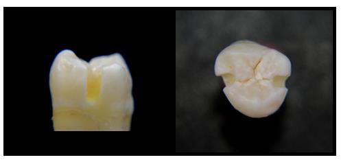 37 Figura 8 - Imagem das cavidades classe II para esmalte e dentina. 4.