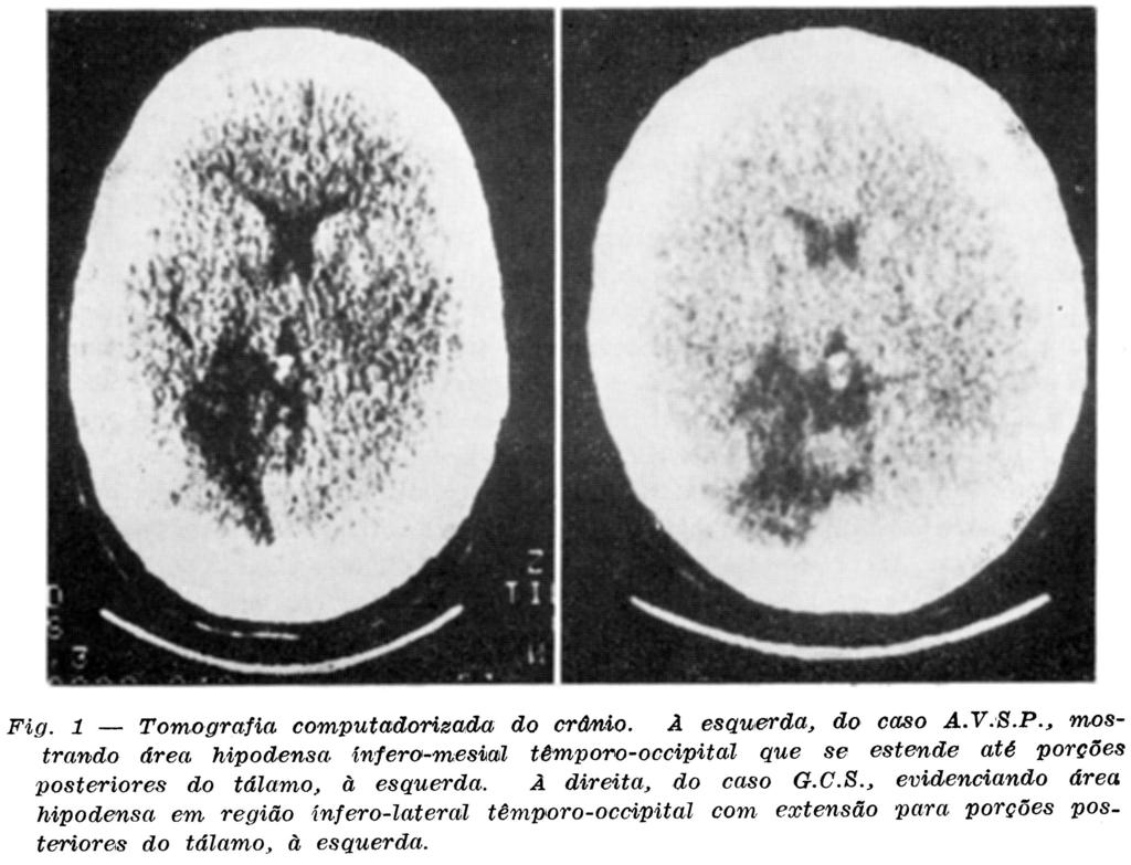 , evidenciando área hipodensa em região ínfero-lateral têmporo-occipital com extensão para porções posteriores do tálamo, à esquerda. Caso 2 G.C.S.