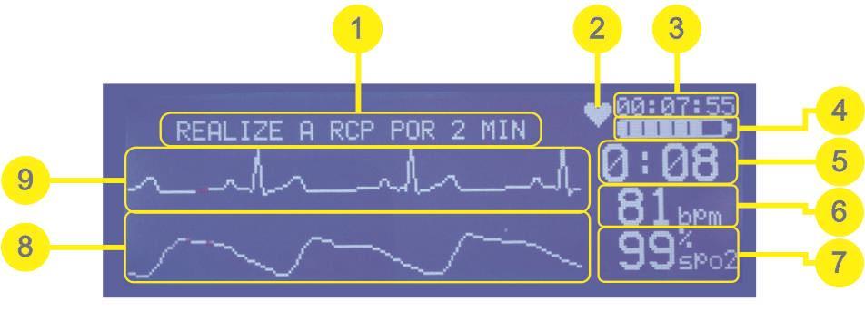 DISPLAY Figura 4 Informações do Display DEA 1- Exibição dos comandos de texto; 6 - BPM - Indicação dos batimentos por minuto do paciente 2 -