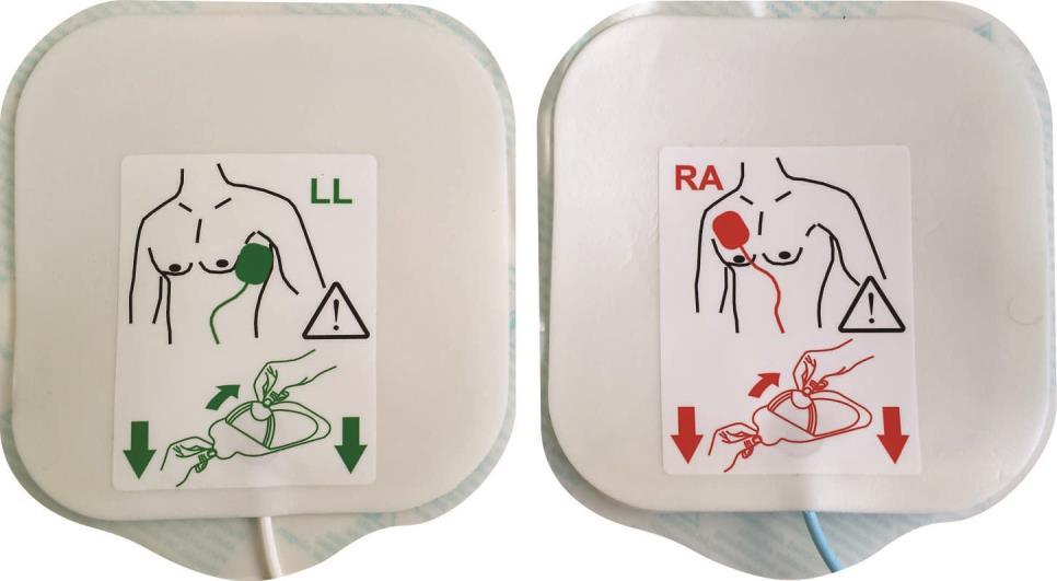 Fixar os eletrodos no tórax do paciente de acordo com a indicação das pás (figura a seguir); Figura 15 Indicação da posição dos eletrodos no tórax do