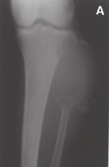 1 Radiografia de um TGC de extremidade proximal do úmero com fratura patológica (paciente nº 36) Tíbia Distal 17% Úmero Proximal 8% Tíbia Proximal 25% Fêmur Proximal 50% Gráfico 4 Distribuição dos