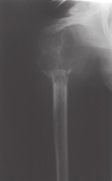 O paciente nº 17, com invasão da articulação tibiofibular proximal, confirmada pela radiografia (fig. 3) e pela tomografia (fig. 4), foi submetido à ressecção da meta- Figs.