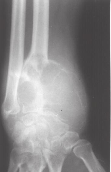 5 Radiografia de pós-operatório após a ressecção da extremidade proximal de fíbula da articulação tibiofibular proximal e parte da extremidade proximal da tíbia (paciente nº 17) a