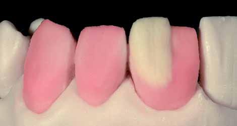 55 Dentina de Mamelo ou Secundária, misturada à Dentina da respectiva cor, aumentando a saturação (croma) na região cervical.