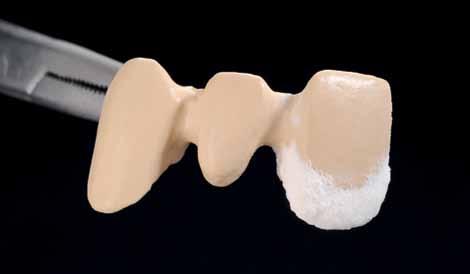 D especial Fig. 77 Após a aplicação e alisamento da superfície cerâmica, a coroa pode ser retirada do troquel e queimada. Fig. 80 Após a correção, o Ombro cerâmico tem uma perfeita adaptação.