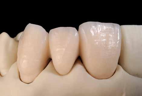 24 Trabalho após a 2ª queima de dentina. Fig.