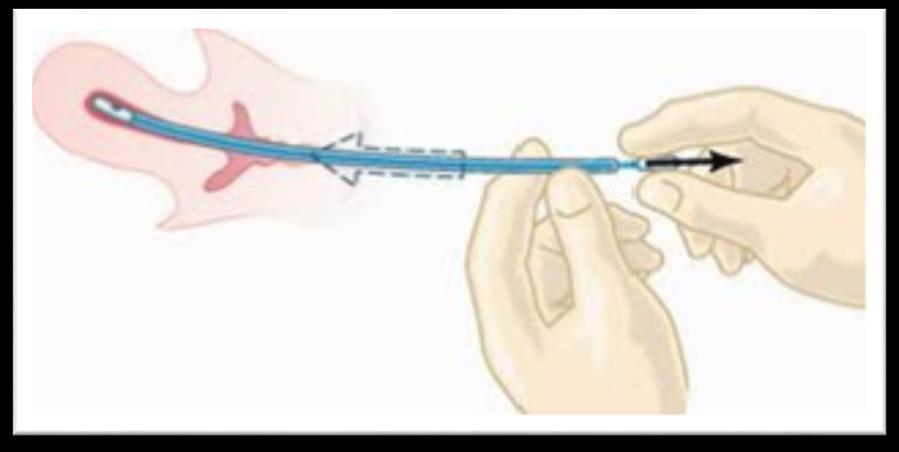 3.2 Coleta de tecido endometrial Todas as pacientes foram submetidas à biópsia de tecido endometrial com o auxílio de uma cânula descartável de pequeno calibre (Pipelle ).