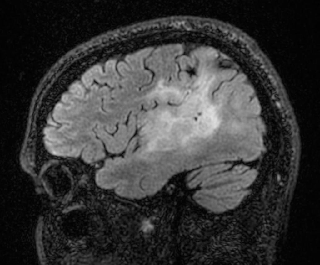 Gliomas Imagem molecular 43 anos, masculino