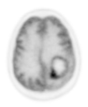 Gliomas Metabolismo de glicose (