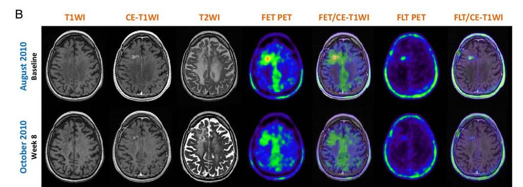 Gliomas Metabolismo de aminoácidos ( F-FDOPA / F-FET / 11 C-MET) Tratamento antiangiogênico