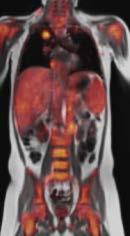 oncology (prostate, ovaries, cervix) Lymphoma Pediatric