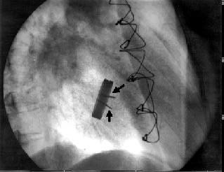 O Doppler-ecocardiograma transesofágico complementou o diagnóstico clínico e fluoroscópico.