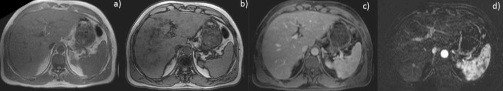 Fig. 14 - Esteatose nodular focal RM da mesma paciente que a figura anterior.