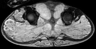 A B D C Fig. 1: A. RMN mostrando múltiplos neurofibromas na medula lombo-sagrada (plano coronal). B. plano sagital. C. RMN ao nível da região inguinal. D. RMN dos membros inferiores com grande envolvimento tumoral à direita.