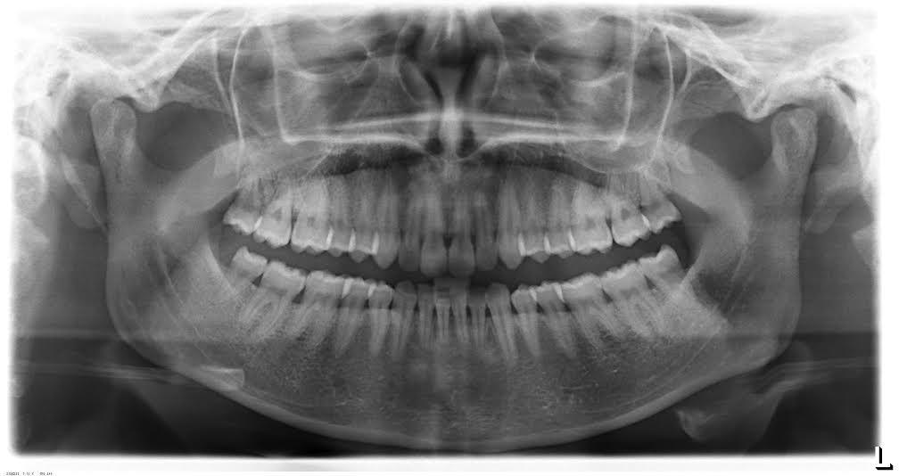 Materiais e Métodos Figura 8- Ortopantomografia sem qualquer anomalia analisada 3. Examinador O Examinador de todas as ortopantomografias e respectivos processos foi sempre o mesmo 4.