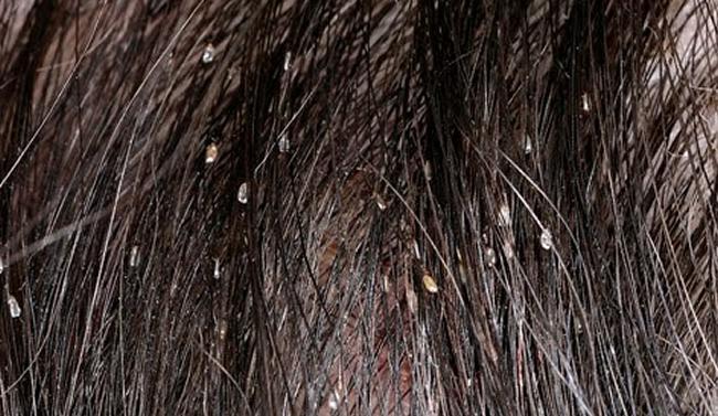 14 Figura 01: Infestação por lêndea em couro cabeludo Fonte:http://www.choyitaslimpias.com/web/wpcontent/uploads/2015/03/pediculosis2.