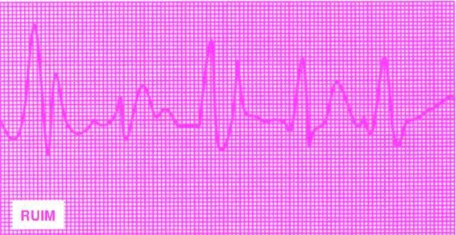 Um eletrocardiograma é apenas um registro gráfico das correntes elétricas produzidas pela atividade do músculo cardíaco (coração) com respeito ao tempo. Figura 22.